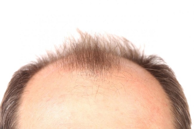 Hair Growth Baldness